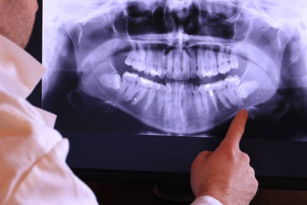 Best Emergency Dentist for Lost Fillings or Crowns in Hagerstown, MD