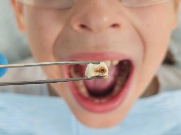 Best Emergency Dental Extractions in Hagerstown, MD